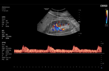 2.kidney-color-with-s-harmonic