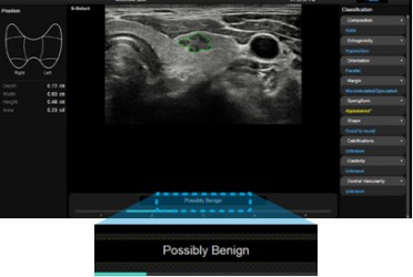 rs80_19_s-detect_thyroid