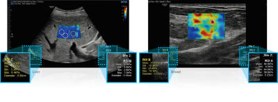 rs85_07_elastography