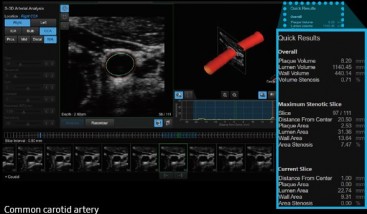 rs85_09_lg_s-3darterial-analysis