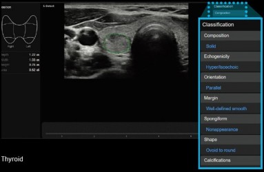 rs85_10_lg_s-detect-for-thyroid